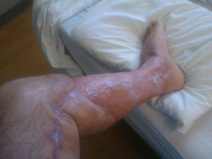 My leg in August.