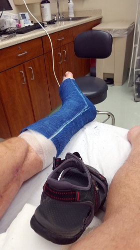 Cast becomes splint